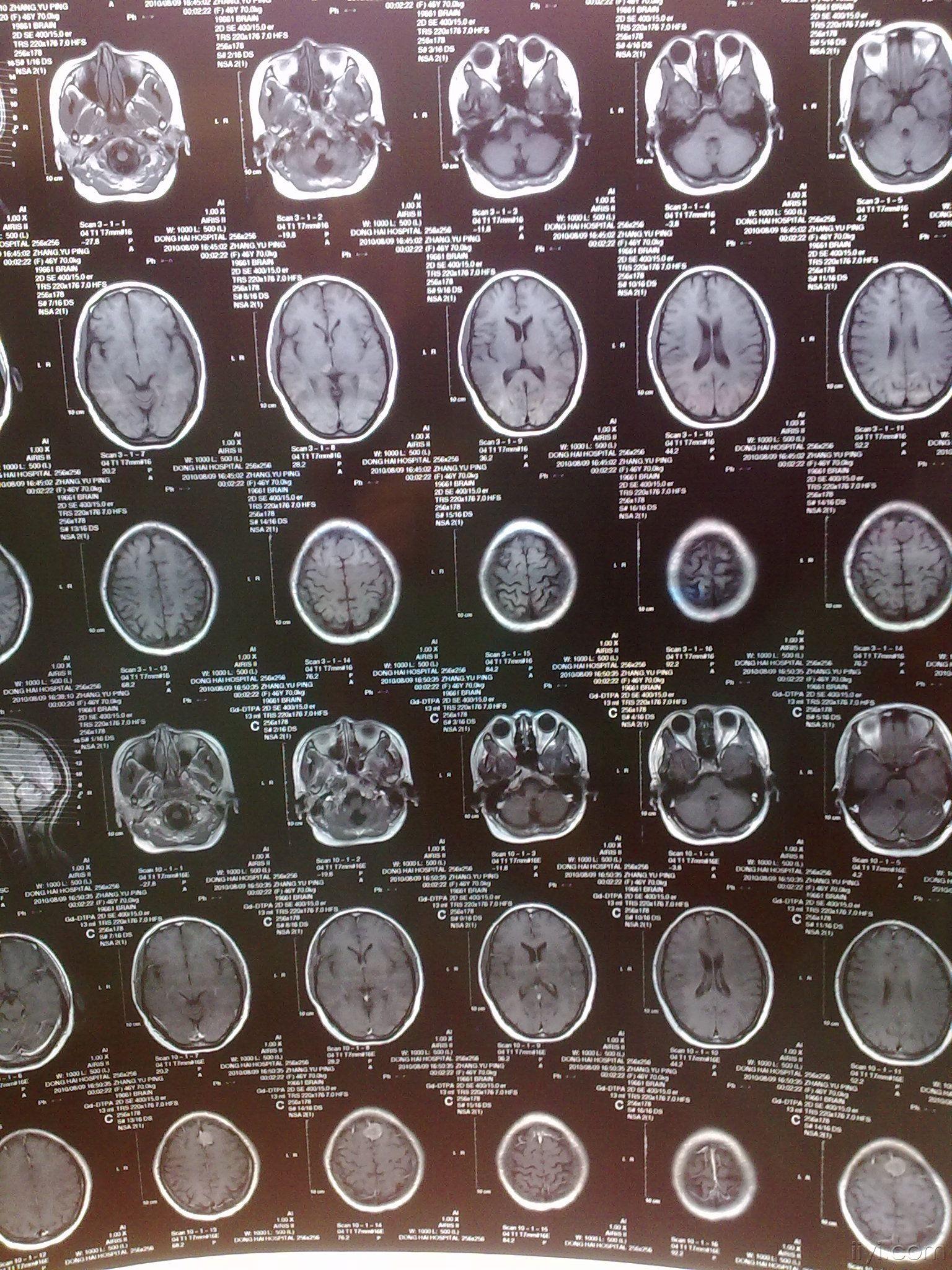 一例矢状窦旁脑膜瘤术前手术术后