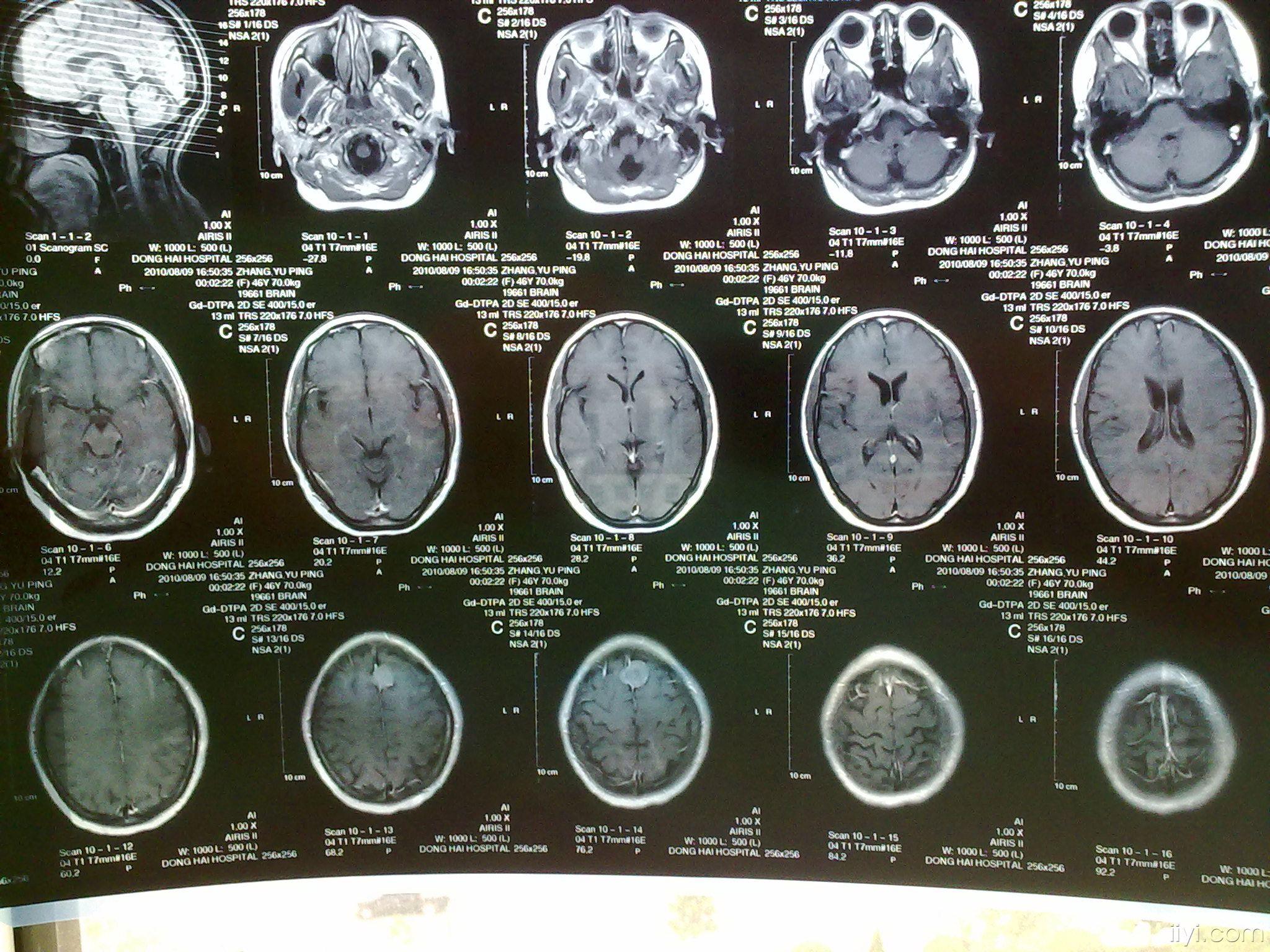 良性脑瘤图片
