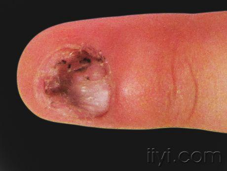 指甲甲乳头瘤图片