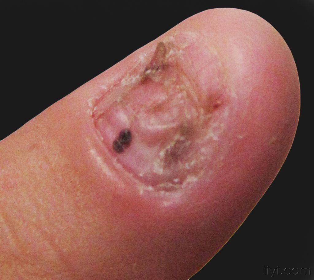 真菌感染指甲早期图片图片
