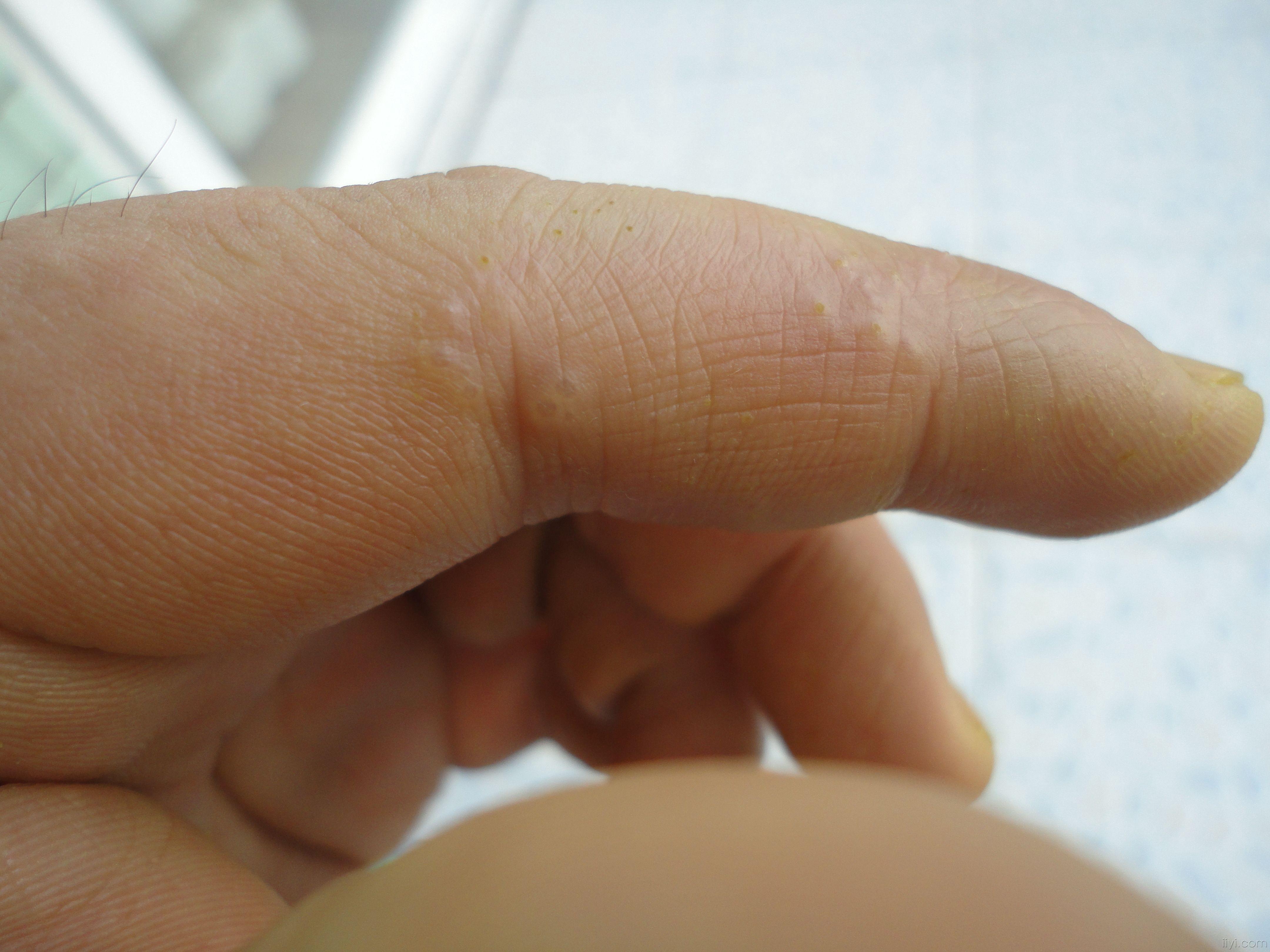指尖角化性湿疹图片