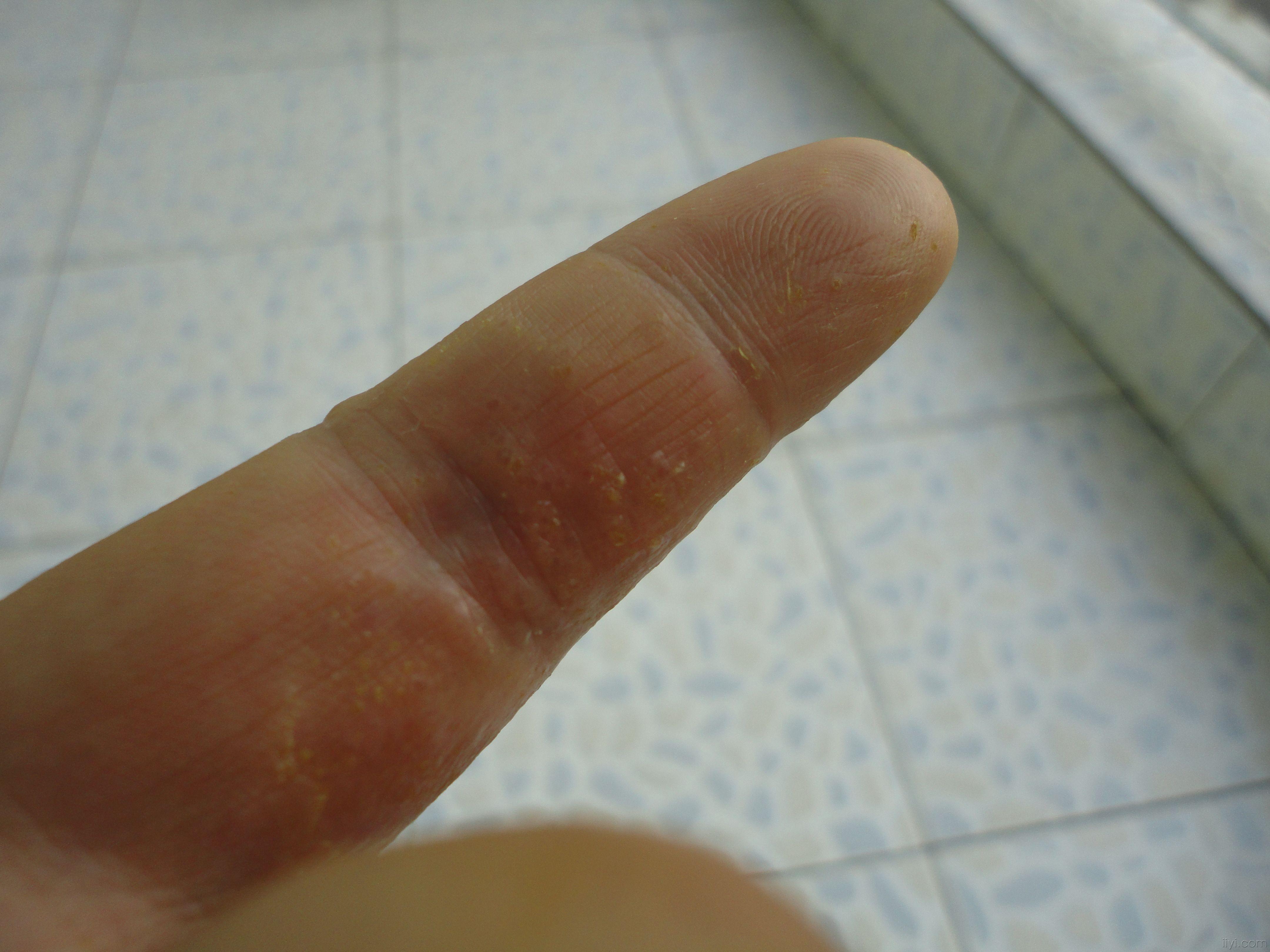 手足皲裂性湿疹图片图片