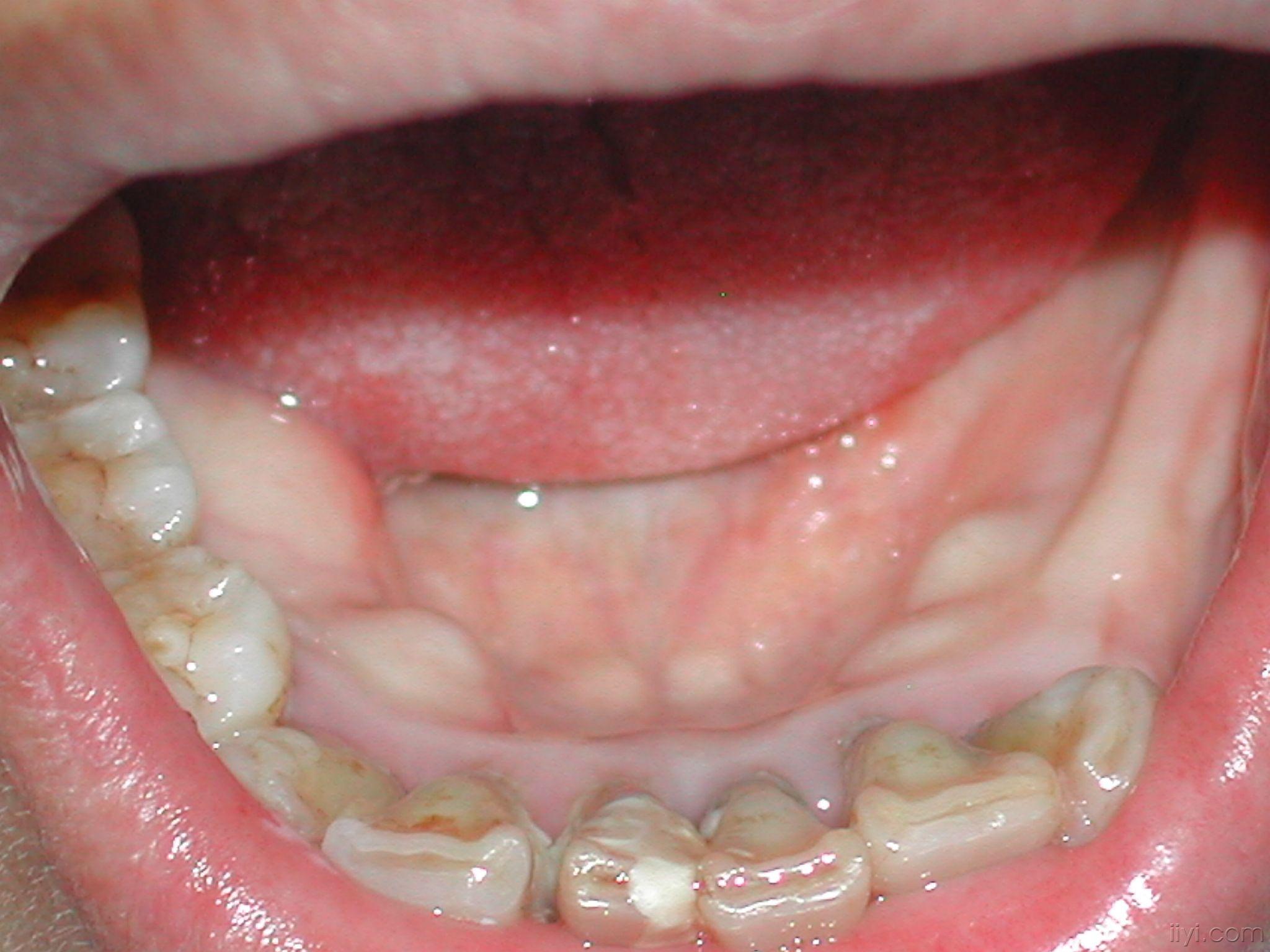 舌侧隆突的位置图片图片
