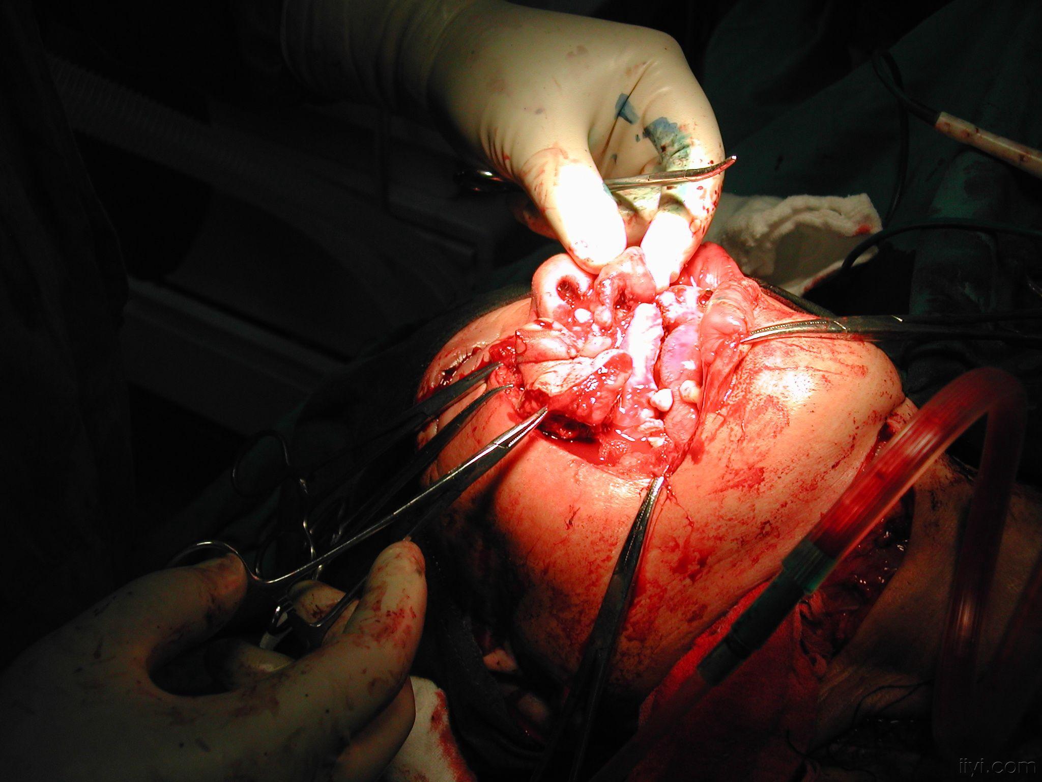 牙龈癌图片手术图片