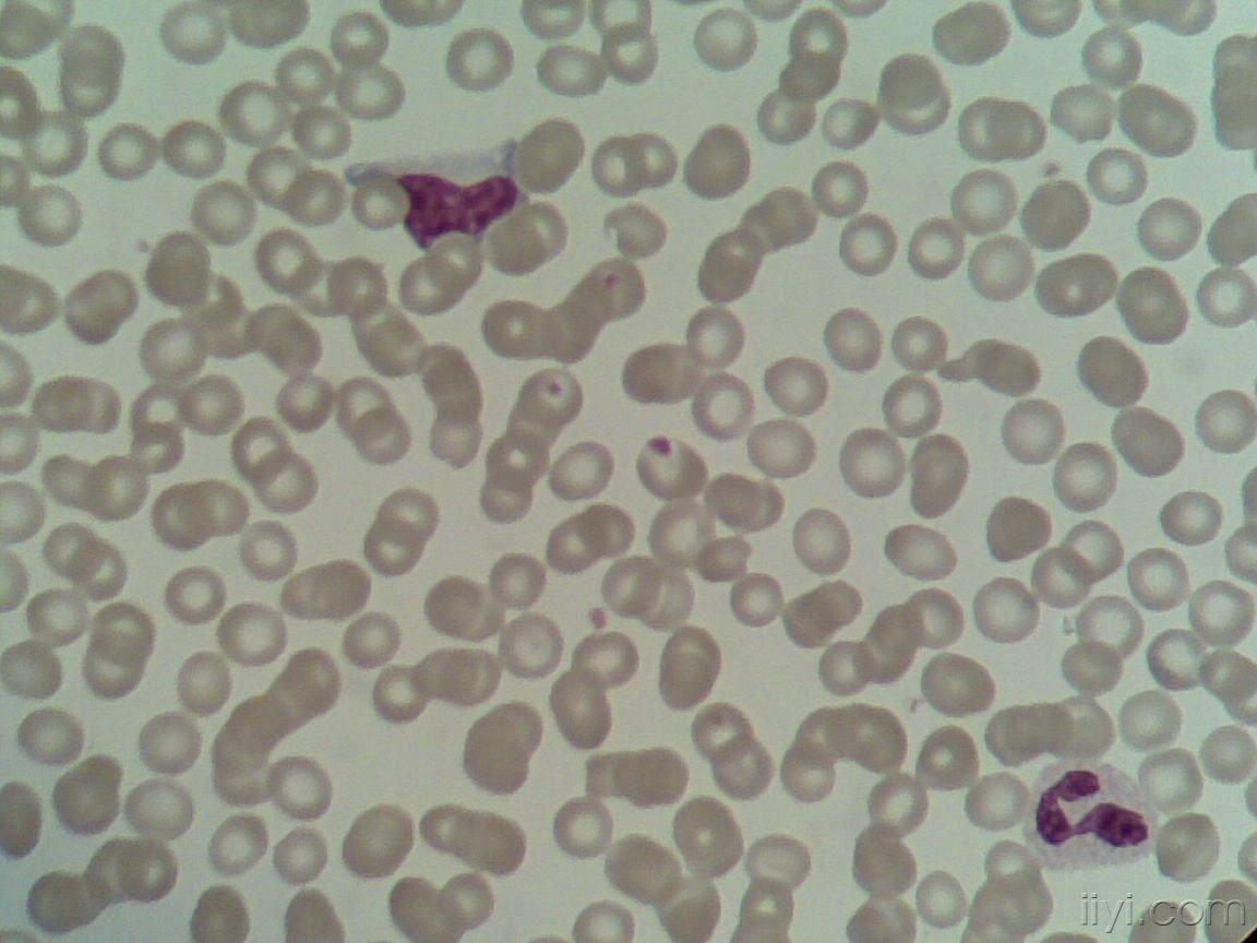 血片中的异型淋巴细胞 (一)
