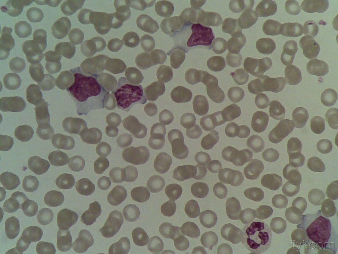 异型淋巴细胞图片
