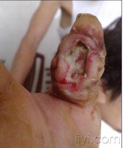 手指脓疱疮图片