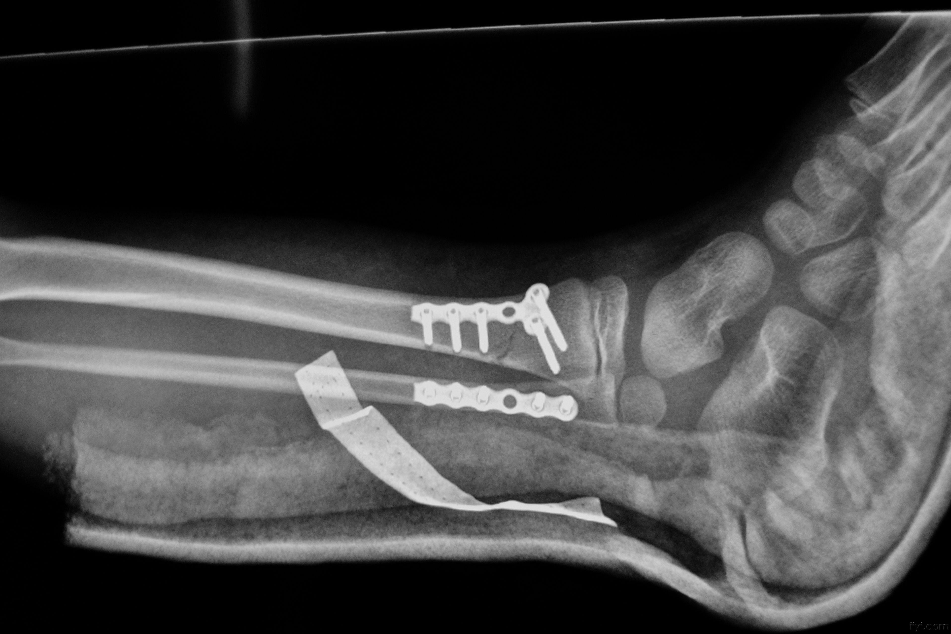 左胫腓骨远端骨折f3小骨锁定钢板固定一例