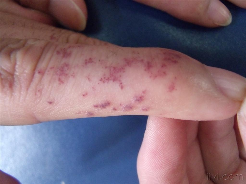 血管角皮瘤多图欣赏