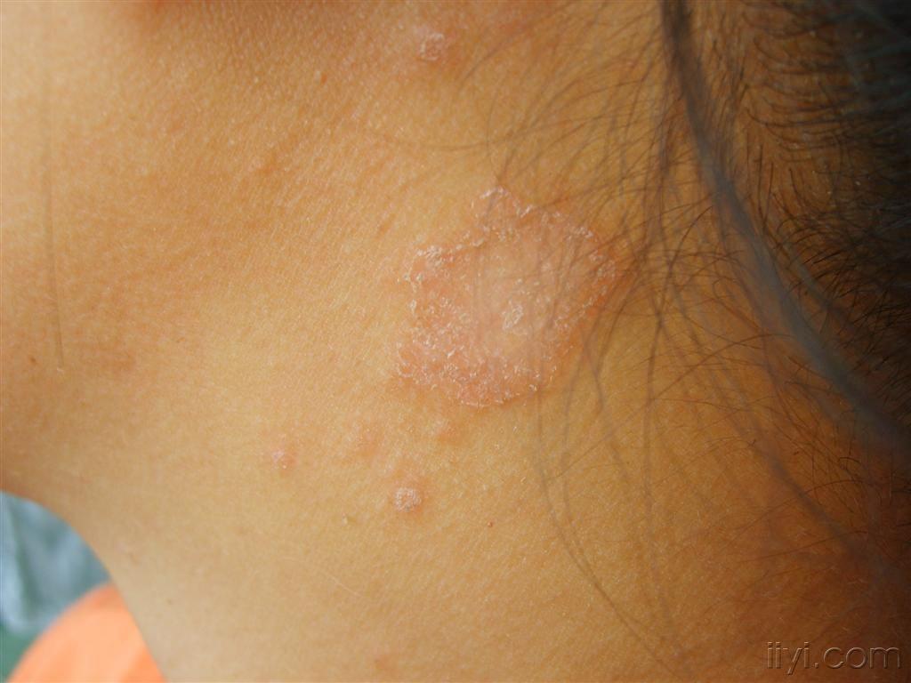 玫瑰糠疹 - 皮肤及性传播疾病讨论版 - 爱爱医医学论坛