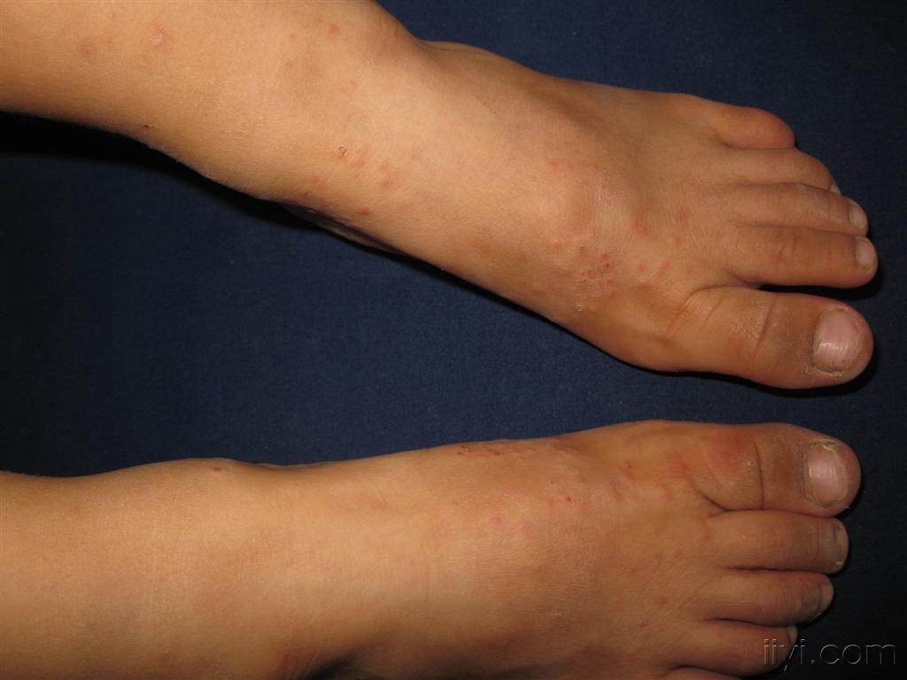 看图识病摩擦性苔藓样疹