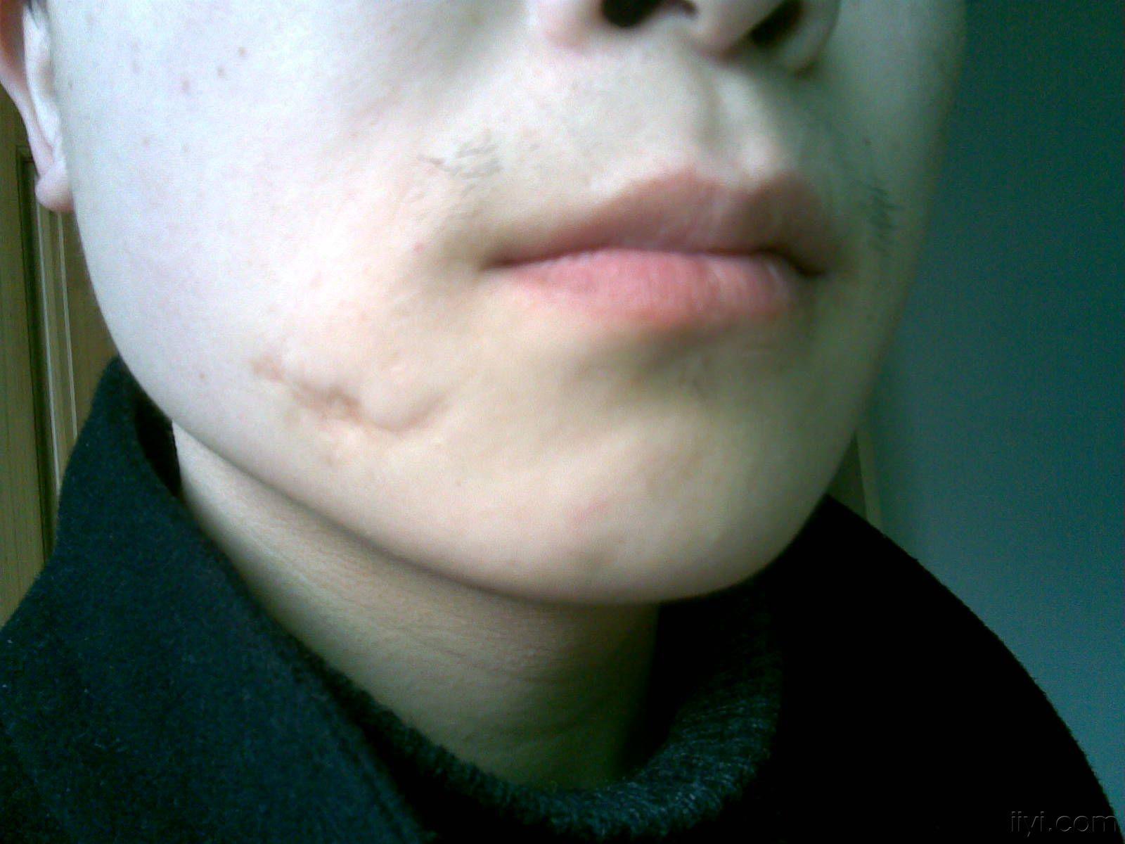 论坛 69 ★临床外科区 69 美容整形专业讨论版 69 求问面部疤痕