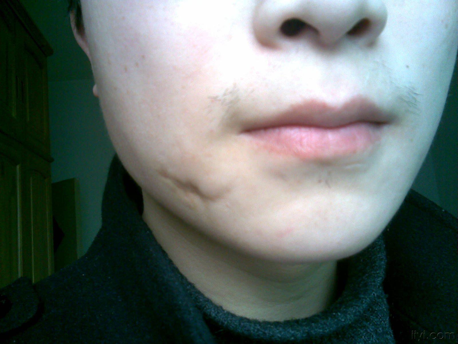 论坛 69 ★临床外科区 69 美容整形专业讨论版 69 求问面部疤痕