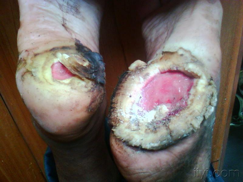 罕见的病例足底生莲花