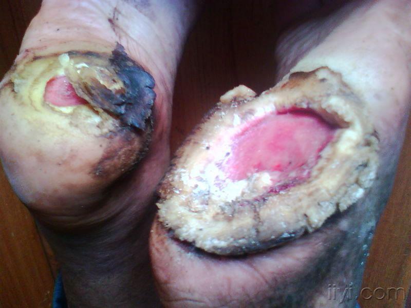 罕见的病例足底生莲花