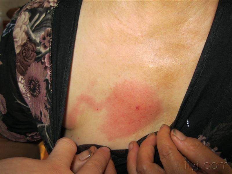 虫咬性皮炎 - 皮肤及性传播疾病讨论版 - 爱爱医医学论坛