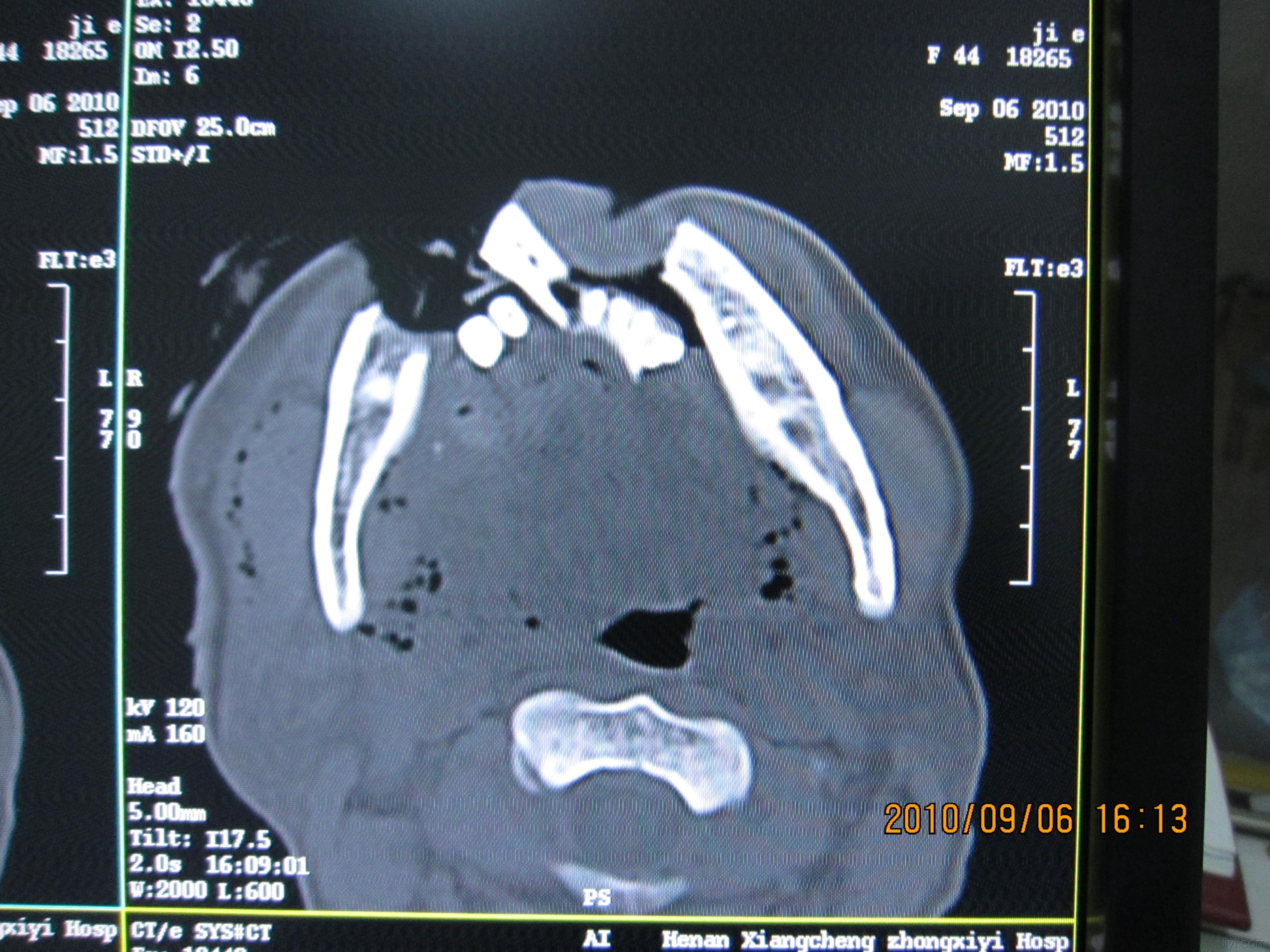 下颌骨ct平扫图片