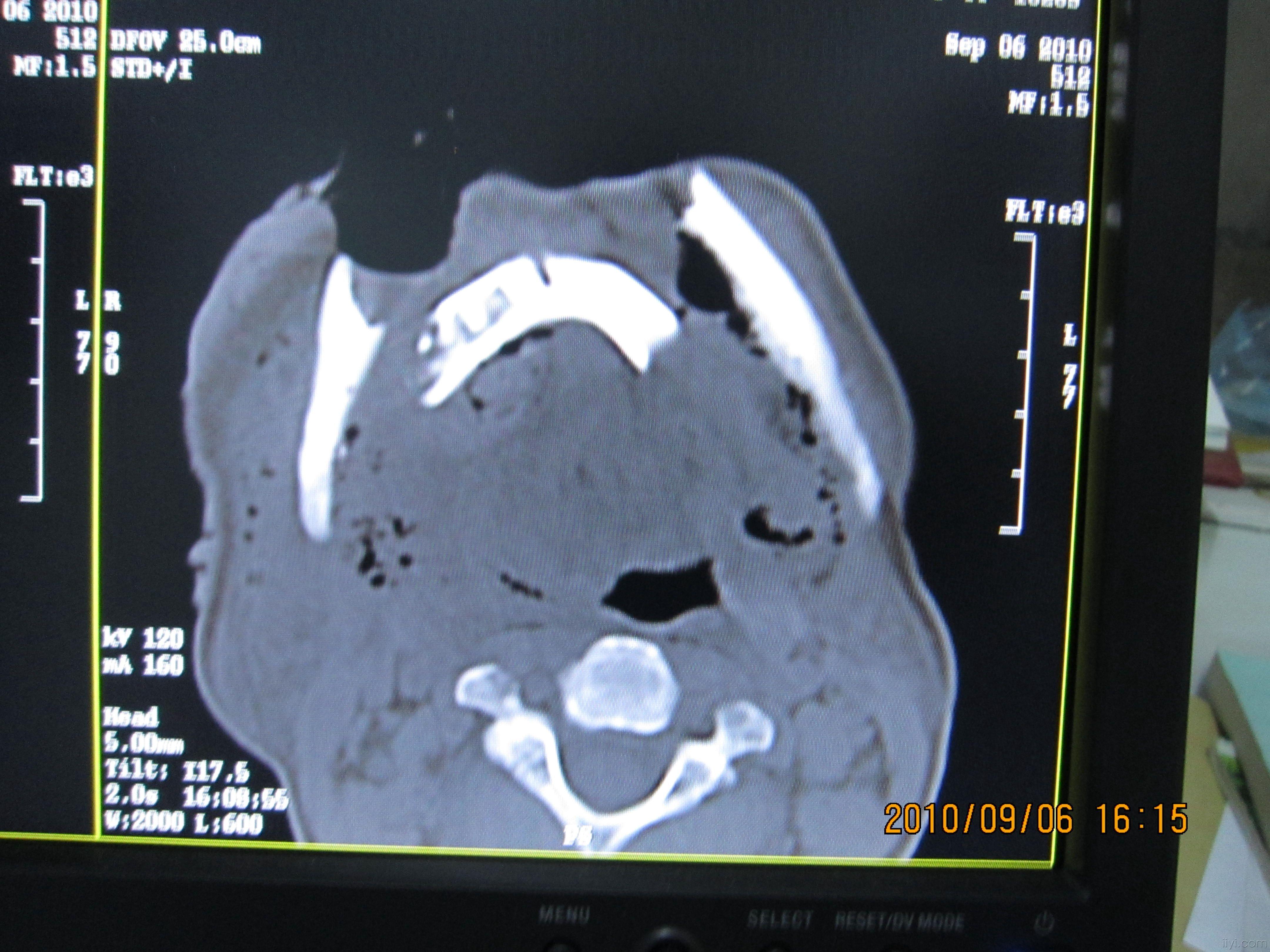 下颌骨ct平扫图片