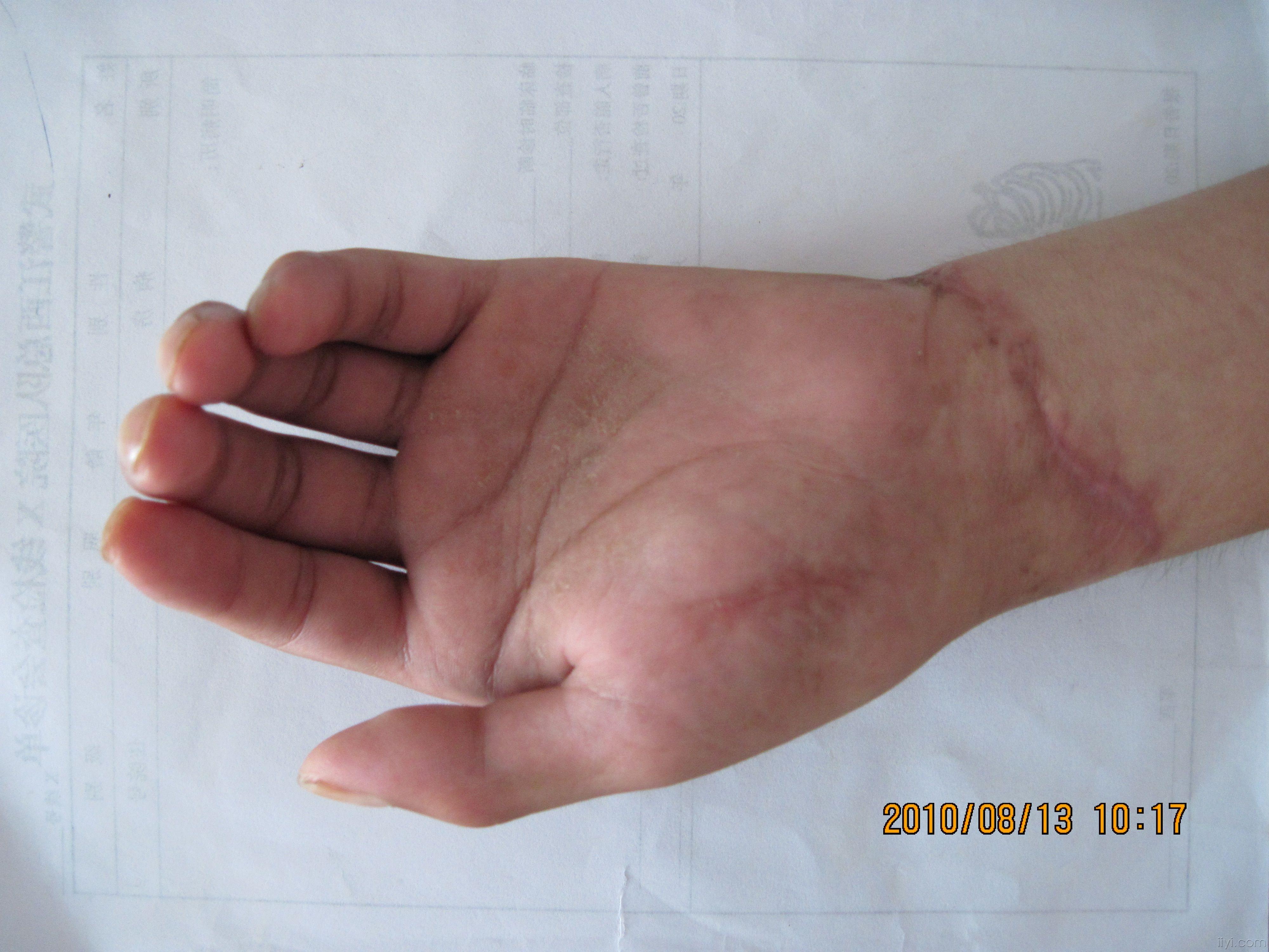 腕部完全离断再植成活一例报告