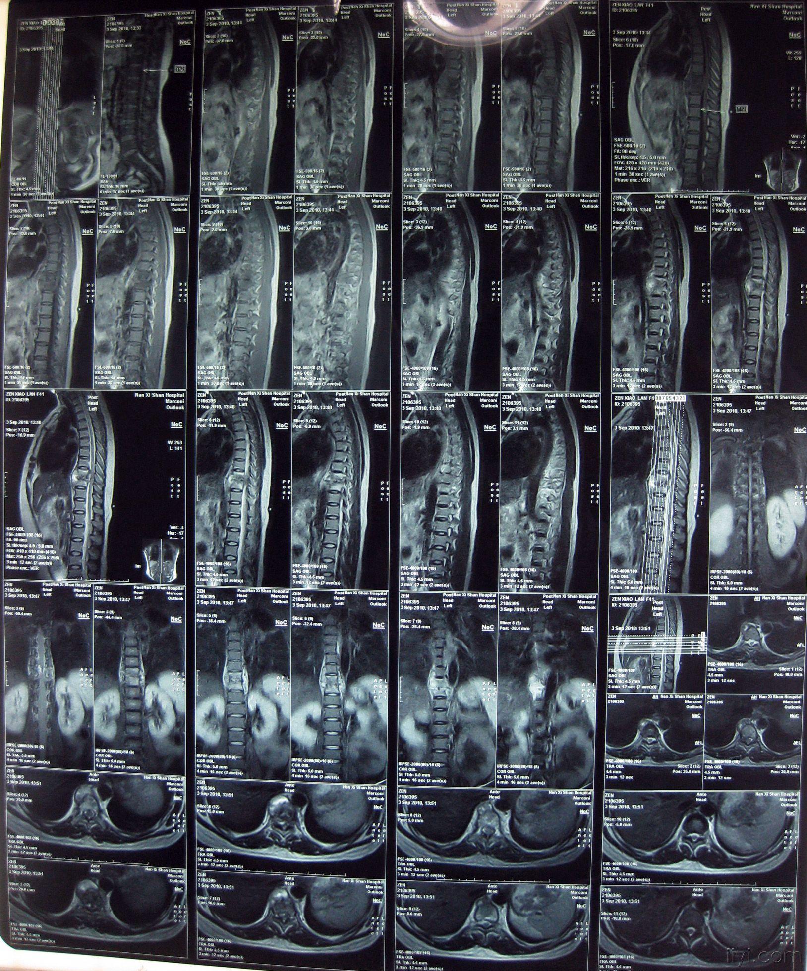骨结核图片 初期图片