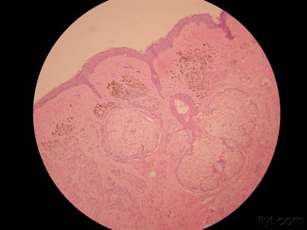 典型病例交流17皮内痣