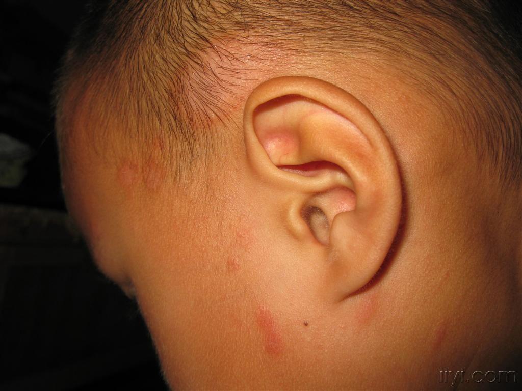 看图识病--------玫瑰糠疹