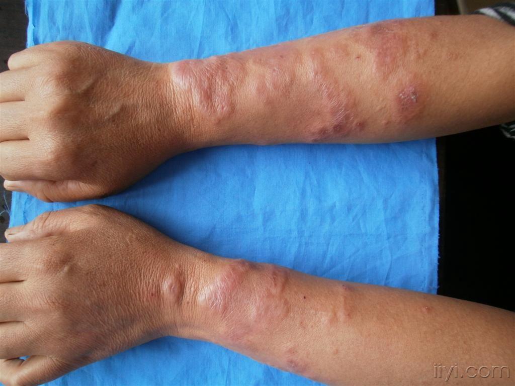 考虑sweet病一例