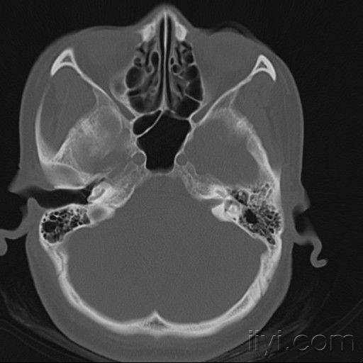 耳部ct图片