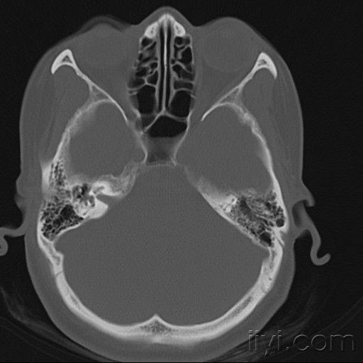 乳突ct平扫图片