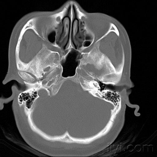 左心耳CT图片