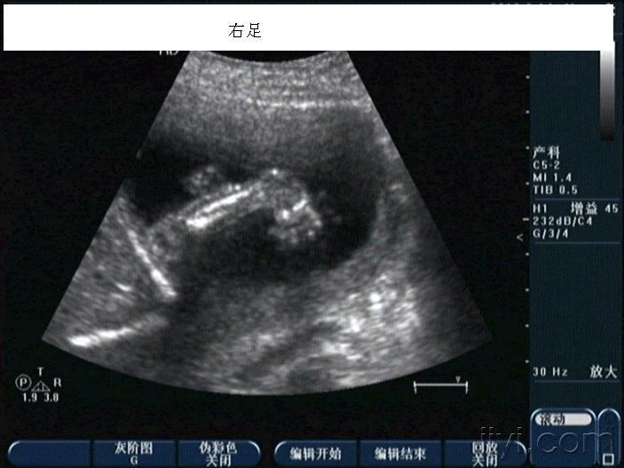 可怕的羊膜带综合症有引产后图片