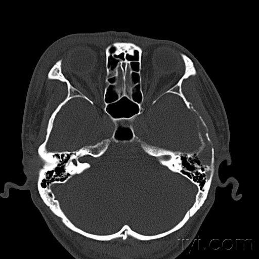 颅骨虫蚀样骨质破坏图片