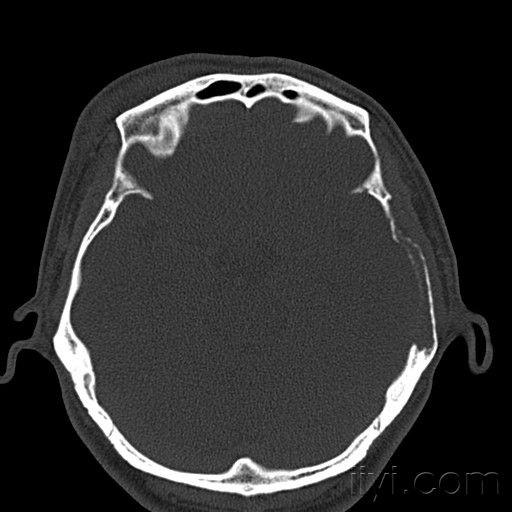 看看这个颅骨破坏是什么