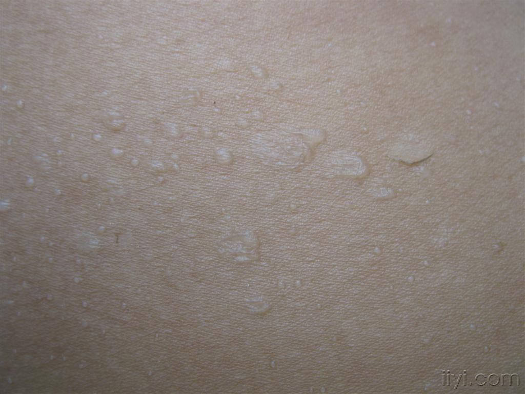 不明原因的皮肤水疱晶形粟粒疹