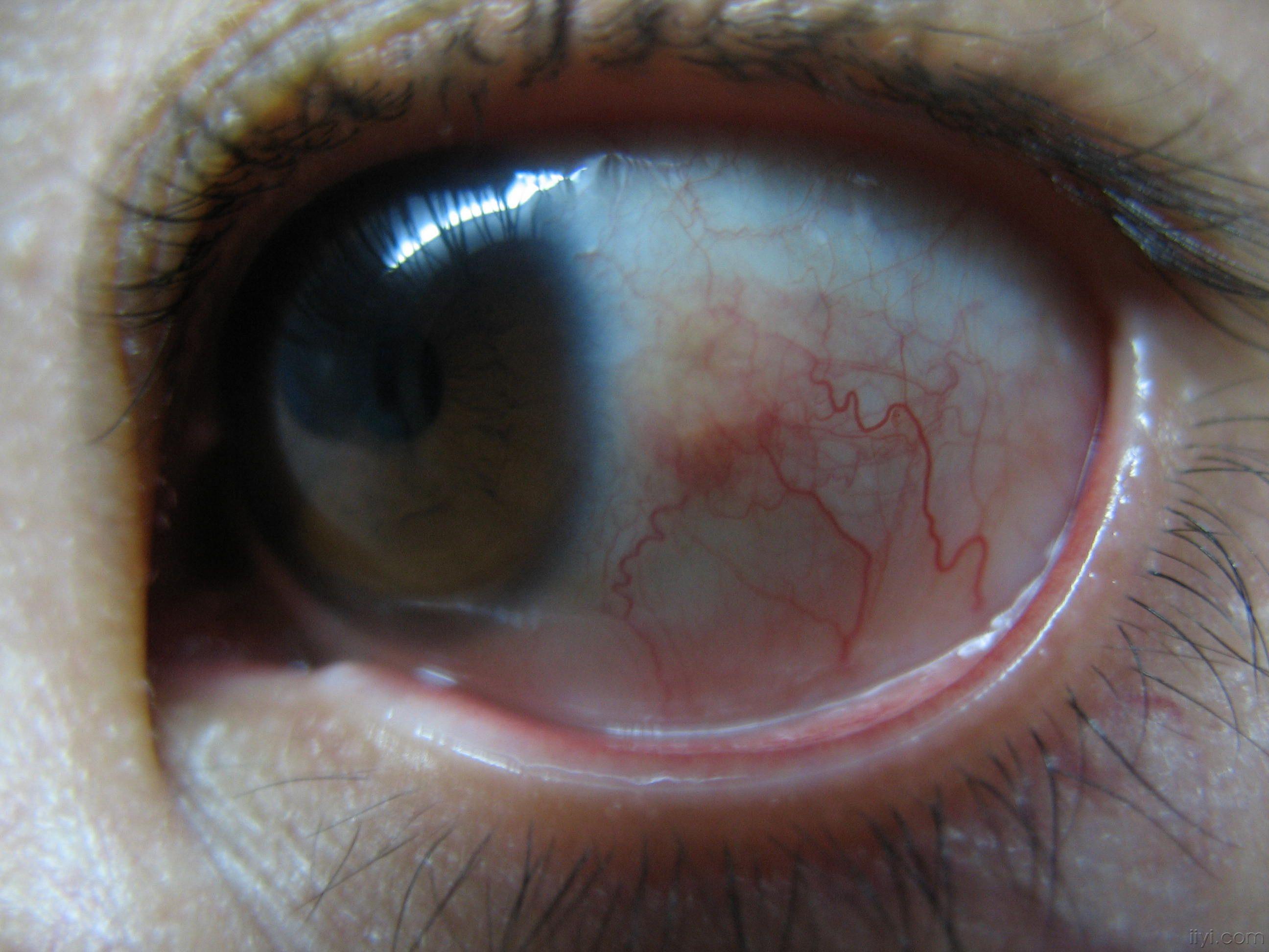红眼病的早期症状图图片