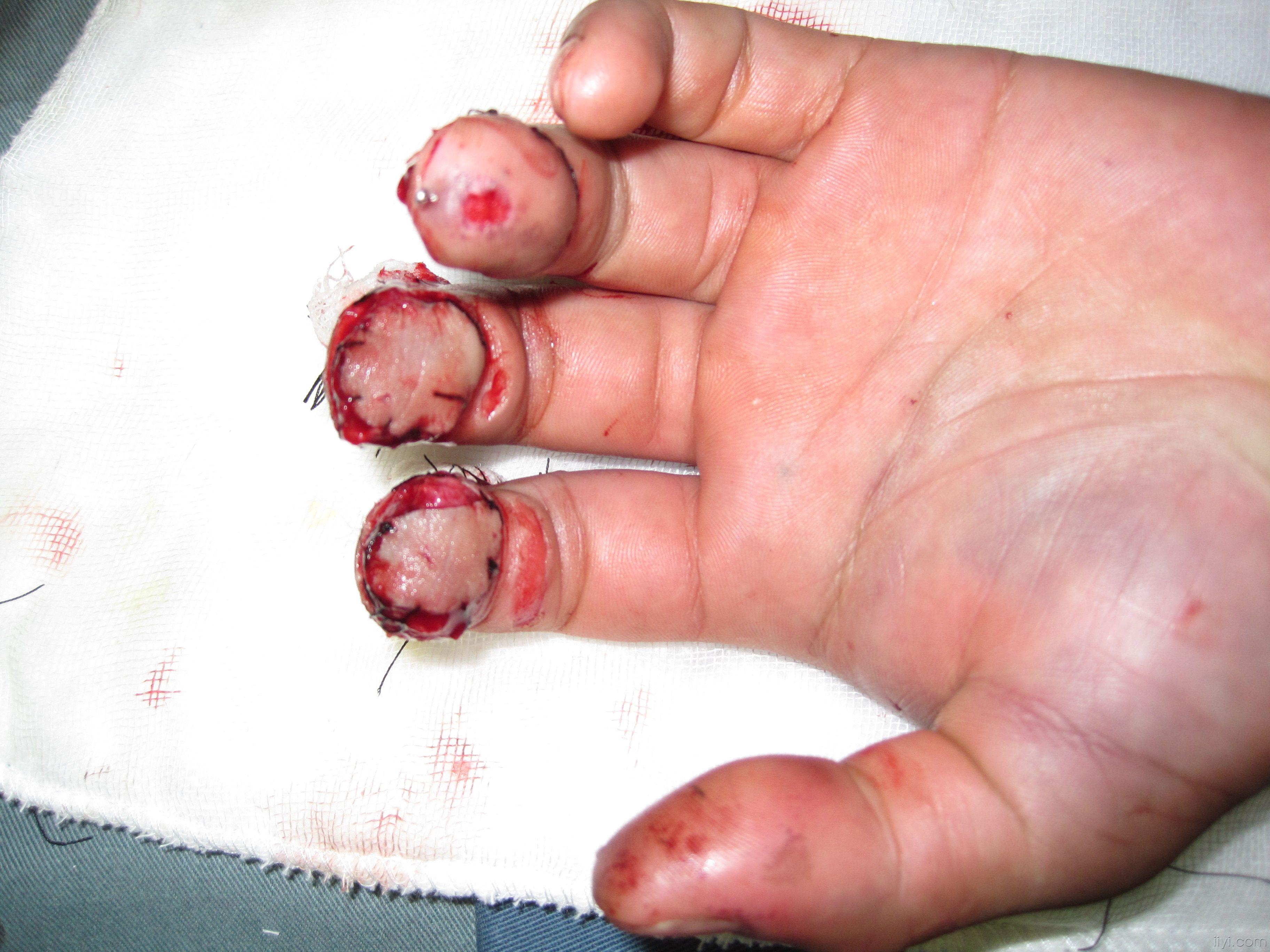 最近做了个指背筋膜蒂皮瓣