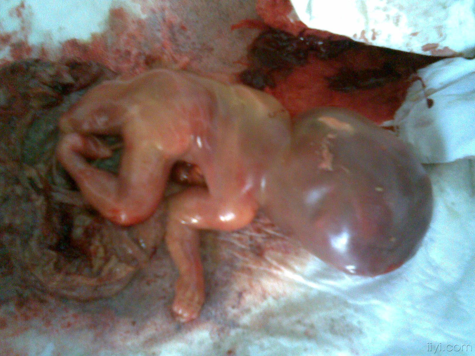 6个月引产的胎儿图片图片
