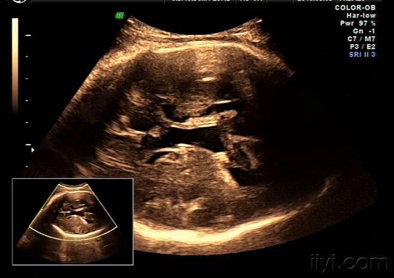 胎儿脑积水三脑室透明膈腔zengerya