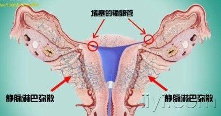 输卵管通液过程图图片