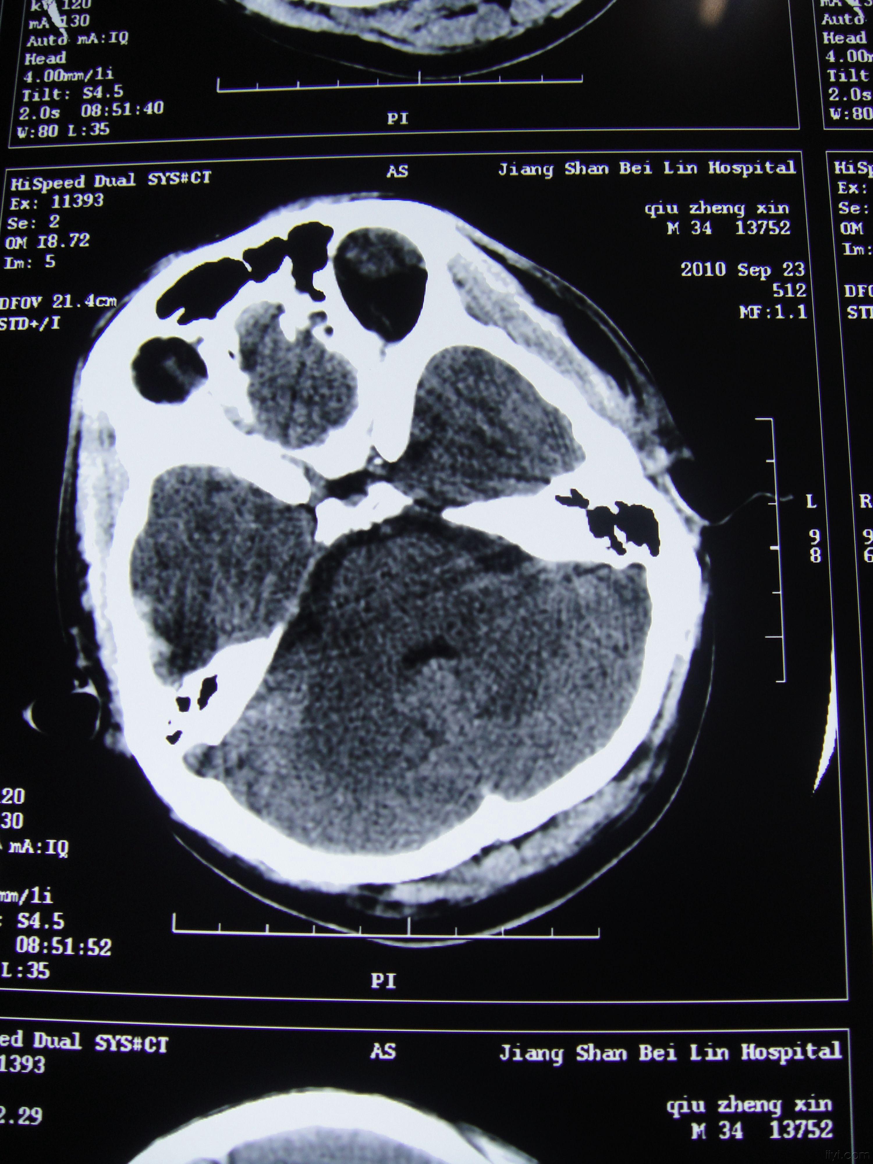 股骨中上段骨折合并腓骨下端骨折