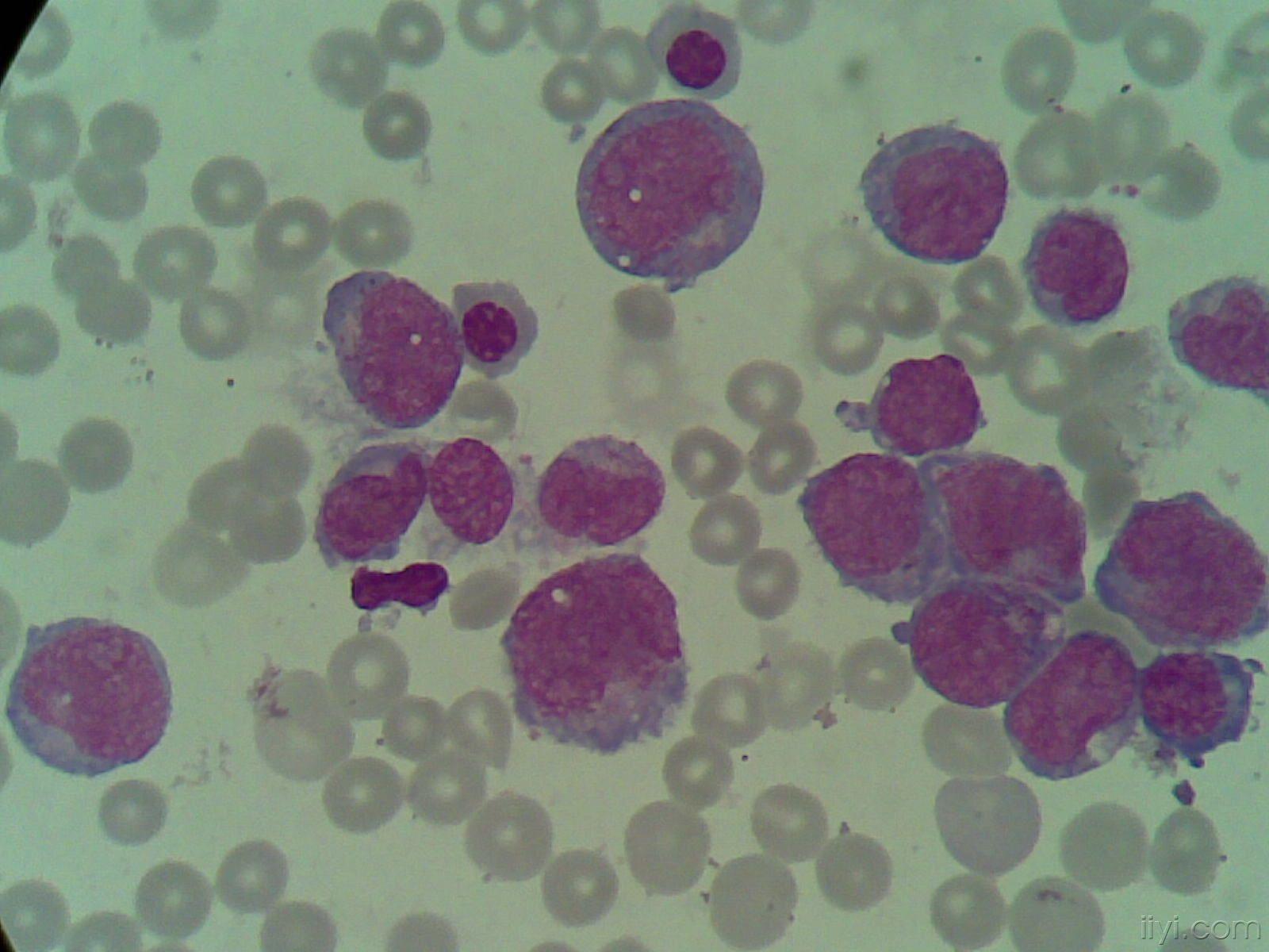 急性髓细胞白血病aml的m4e0型