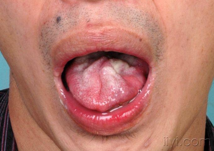 舌强征一例