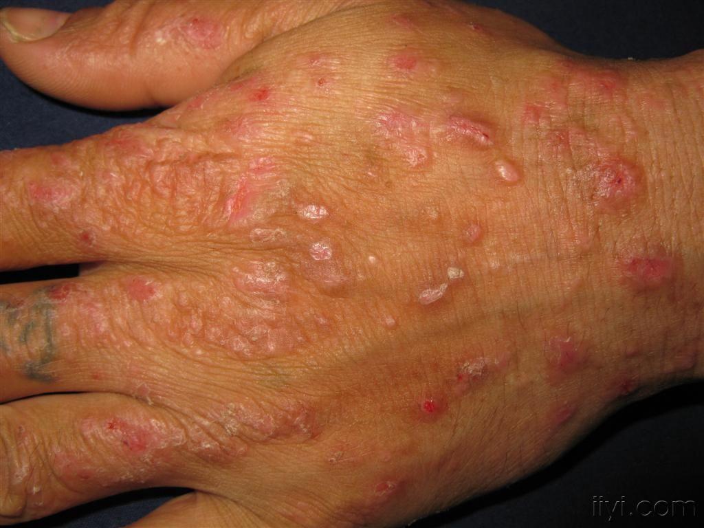 结节性痒疹的早期图片图片