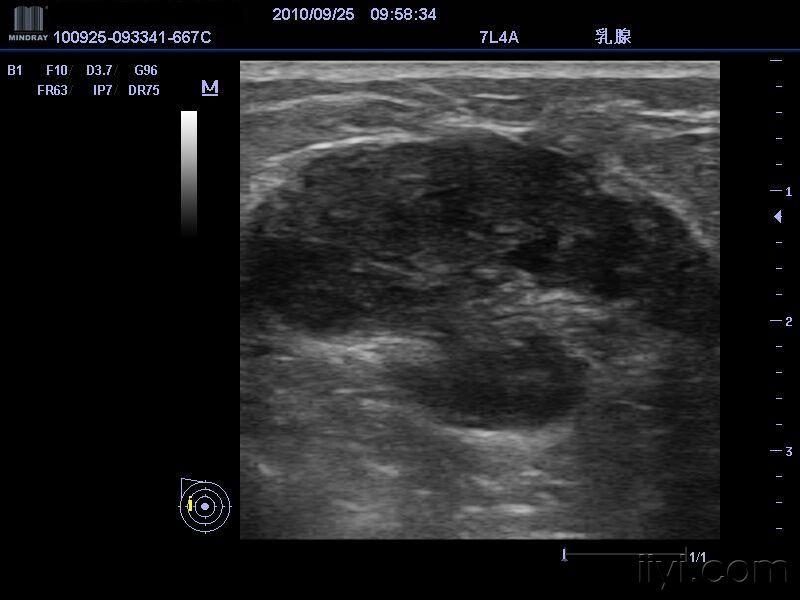 乳腺肿块,有随访 - 超声医学讨论版 - 爱爱医医学论坛