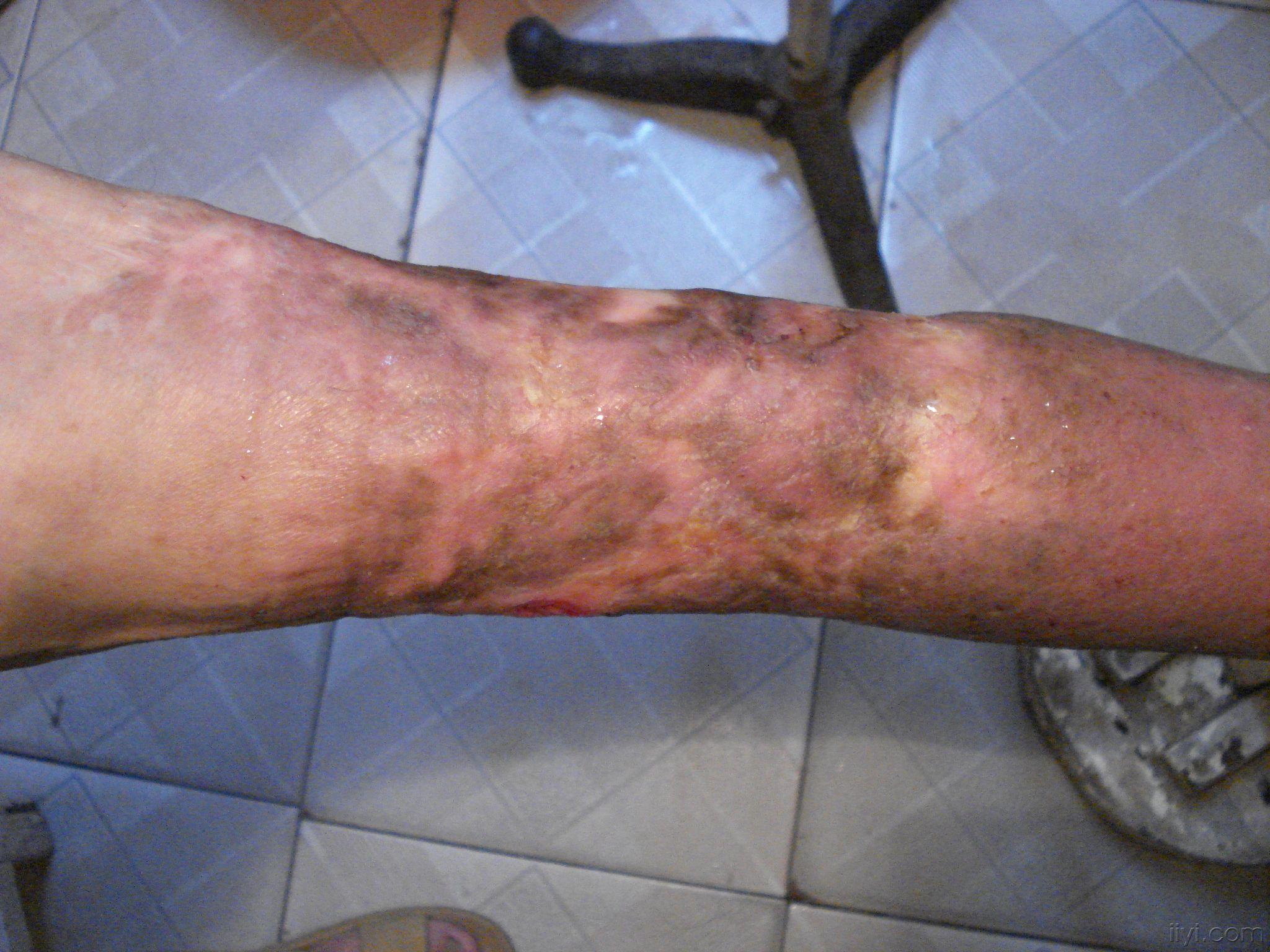 右小腿瘢痕超大溃疡三年大家来支招该怎么干