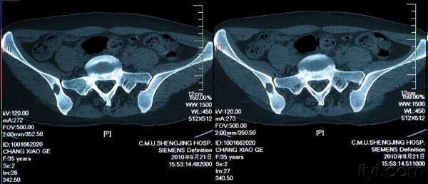 妻子患病髂骨占位——跪求!!大家帮看看长了什么东西