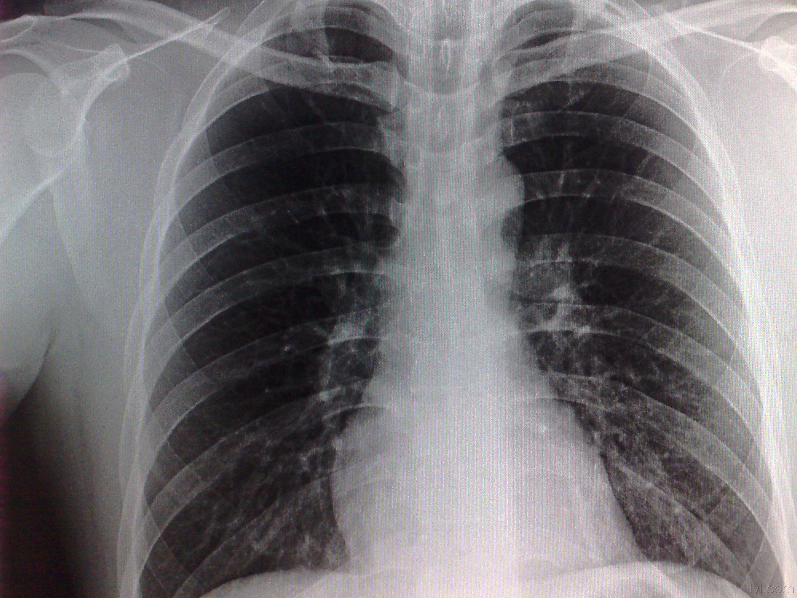 支气管炎医院排名_支气管炎医院证明(2)