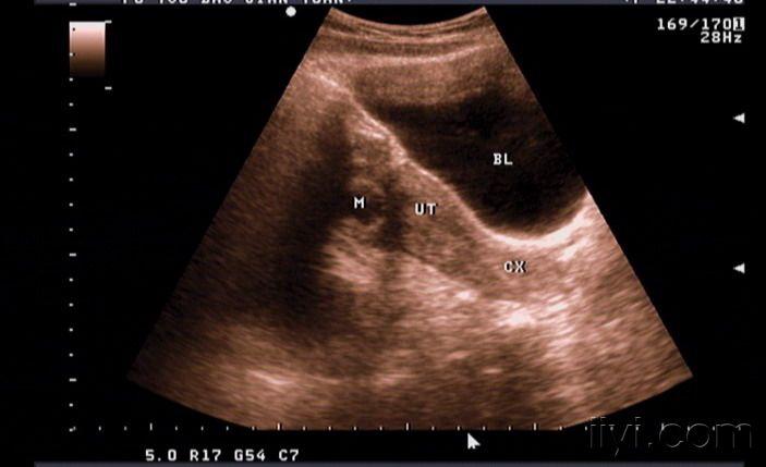 请大家看一下,是不是黄体血肿? - 超声医学讨论版 - 爱爱医医学论坛