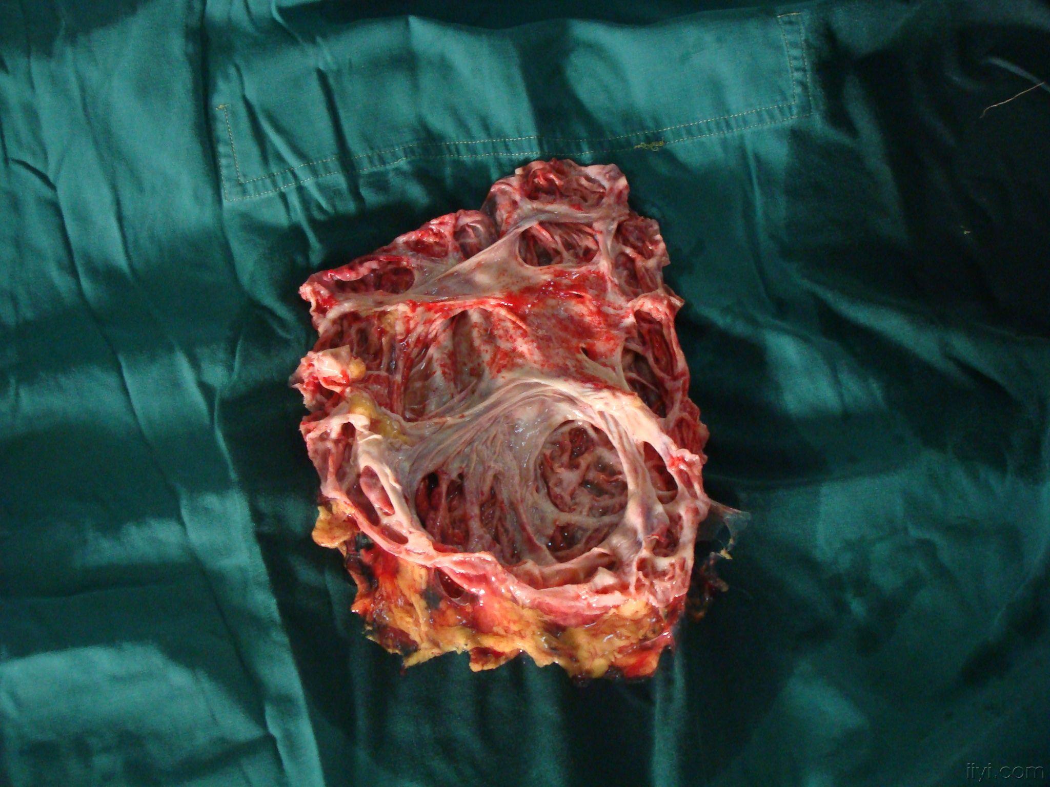 报告一例特大肾积水相当少见的大