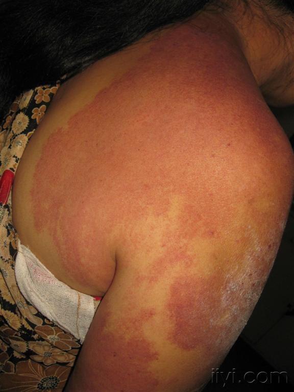 看图识病毛细血管瘤神经性皮炎